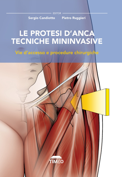 Le protesi d’anca. Tecniche mininvasive. Vie d’accesso e procedure chirurgiche