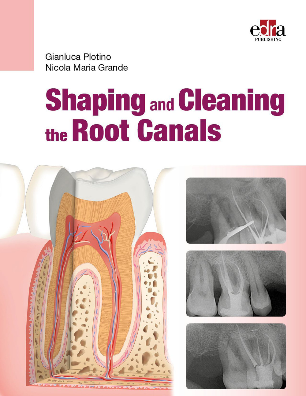 Shaping and Cleaning the Root Canals