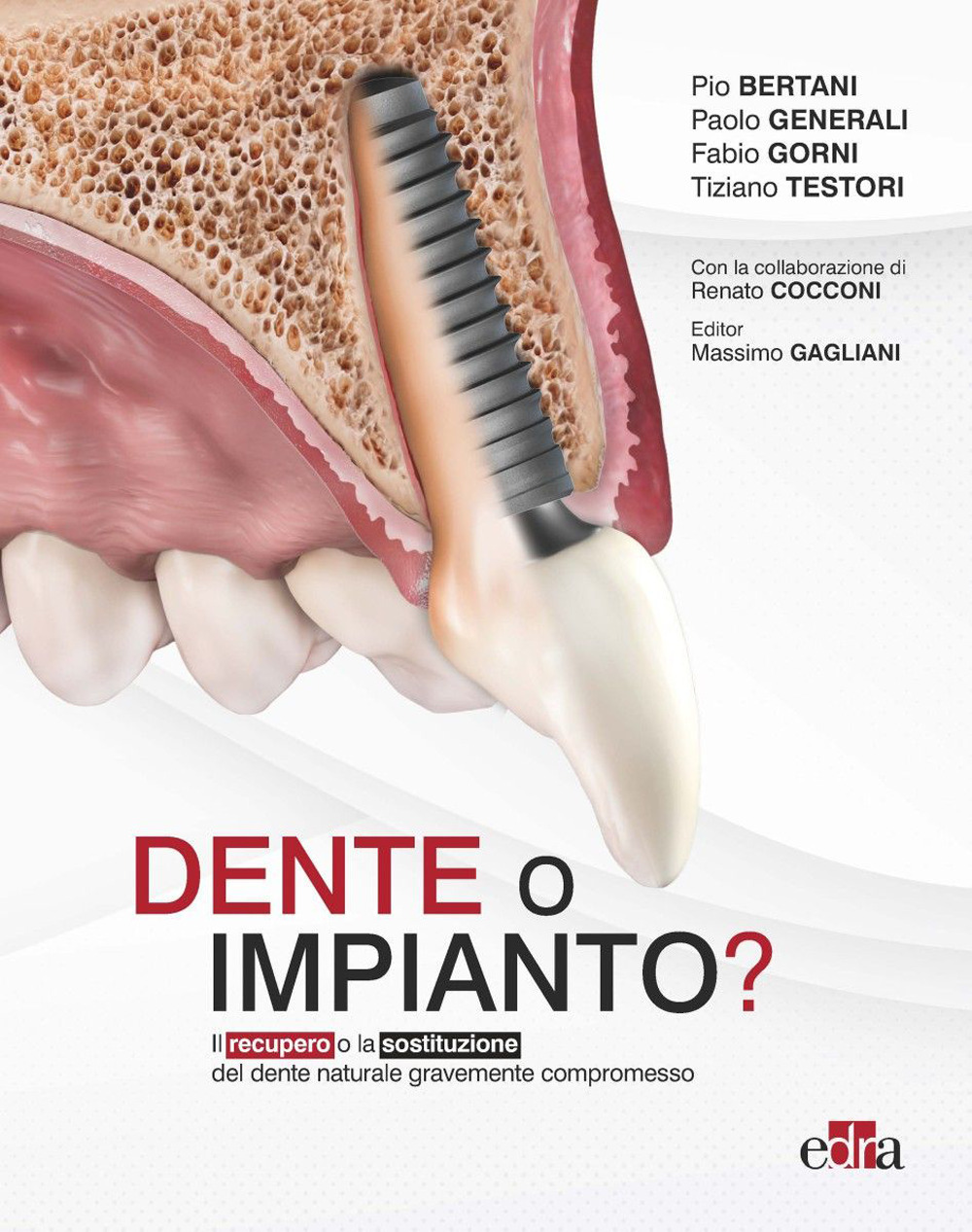 Dente o impianto? Il recupero o la sostituzione del dente naturale gravemente compromesso