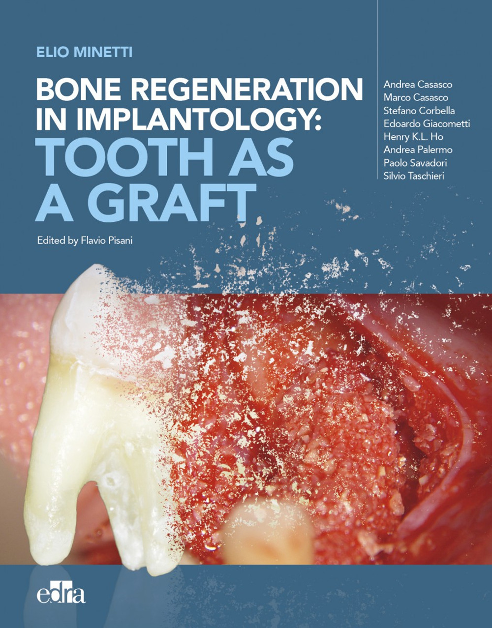 Bone regeneration in implantology: tooth as a graft