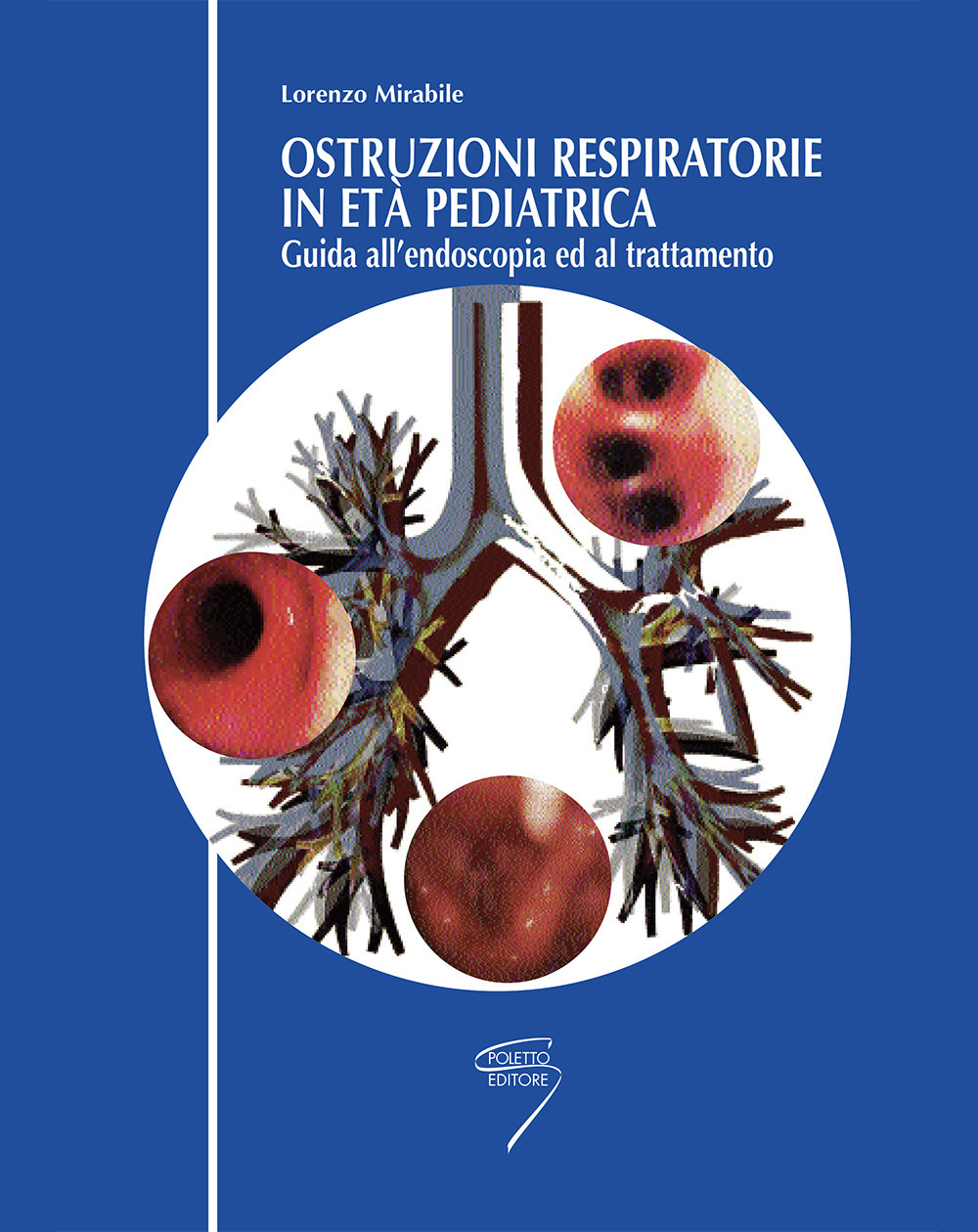 Ostruzioni respiratorie in pediatria. Guida all'endoscopia ed al trattamento
