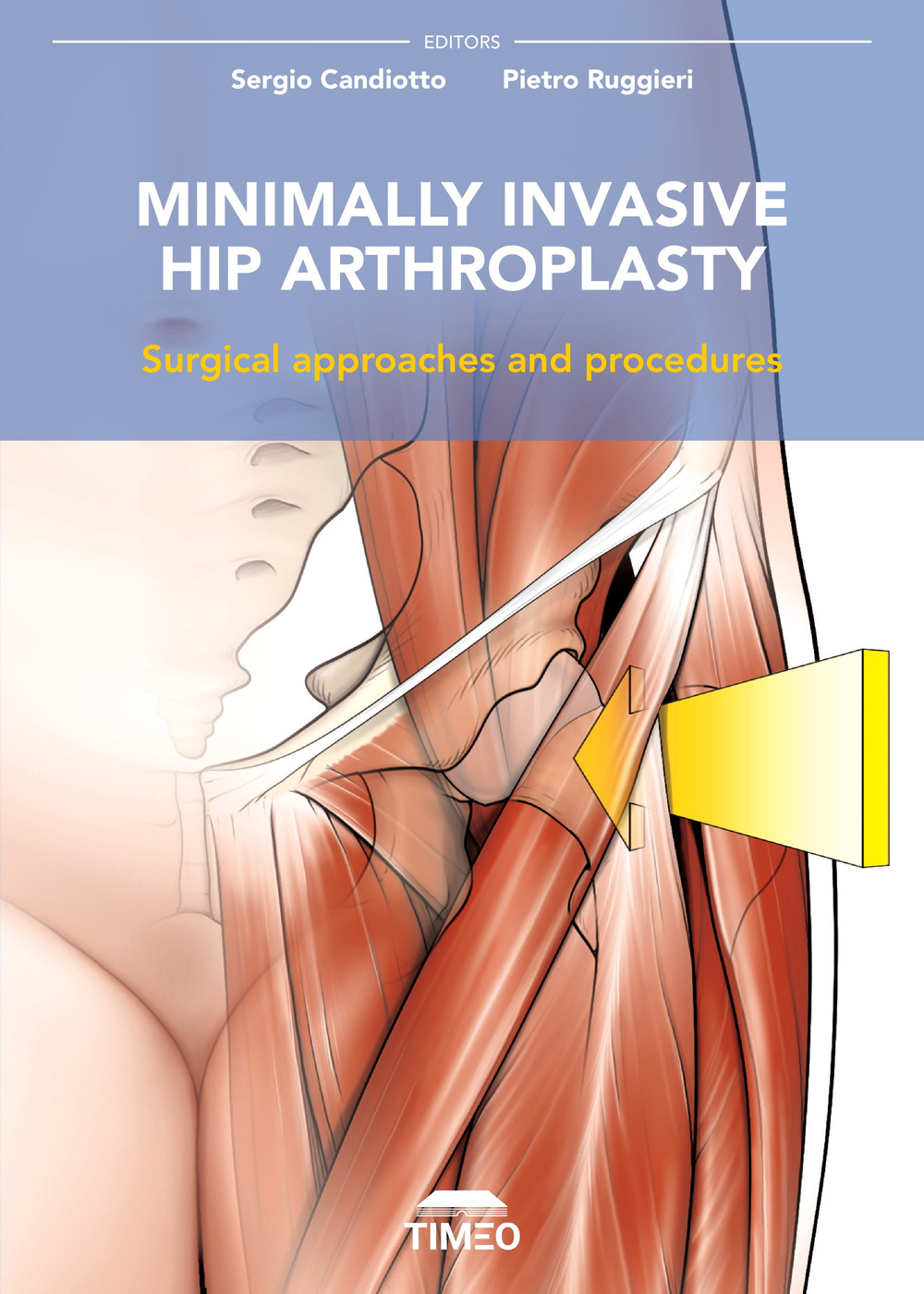 Minimally invasive hip arthroplasty. Surgical approaches and procedures