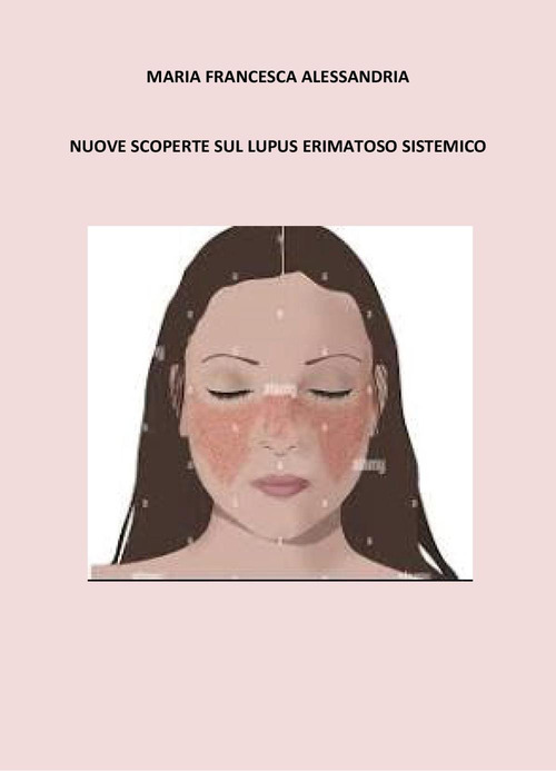 Nuove scoperte sul lupus erimatoso sistemico