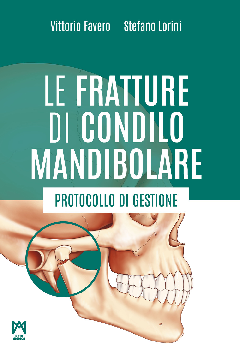 Le fratture di condilo mandibolare. Protocollo di gestione